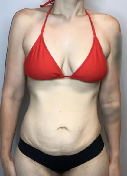 Before Image: Mommy Makeover - front