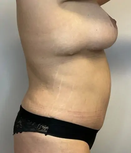 After Image: Mommy Makeover - right-side