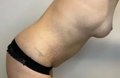 After Image: Mommy Makeover - other