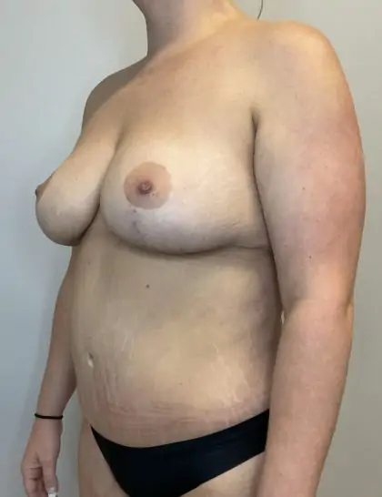After Image: Mommy Makeover - left-front-oblique