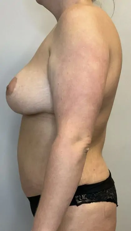 After Image: Mommy Makeover - left-side