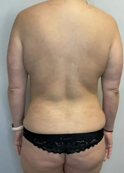 After Image: Mommy Makeover - back