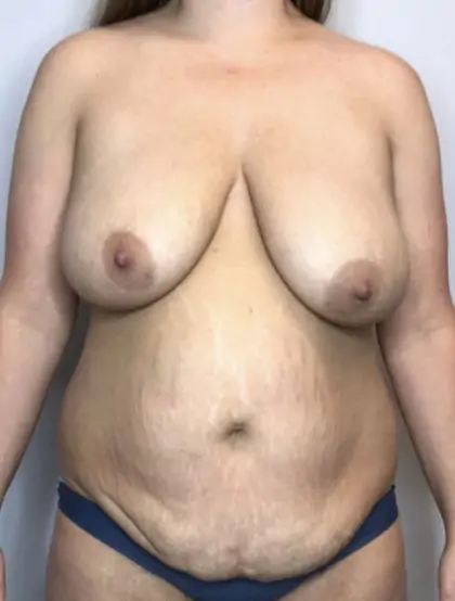 Before Image: Mommy Makeover - front