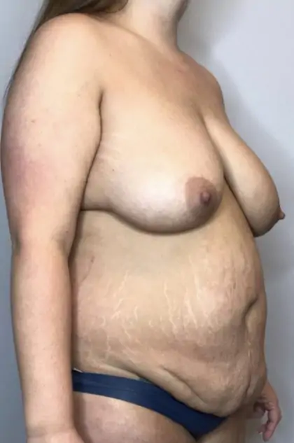 Before Image: Mommy Makeover - right-front-oblique