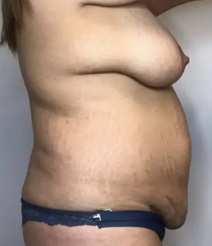 Before Image: Mommy Makeover - right-side