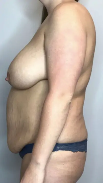 Before Image: Mommy Makeover - left-side