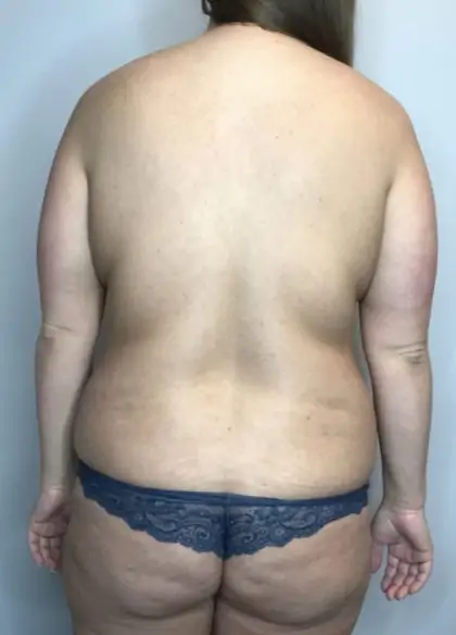 Before Image: Mommy Makeover - back