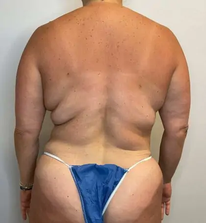 After Image: Mommy Makeover - back