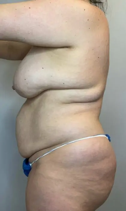 Before Image: Mommy Makeover - left-side