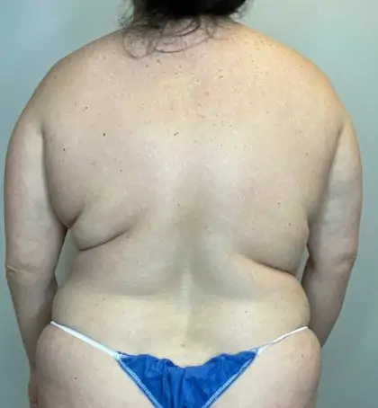 Before Image: Mommy Makeover - back