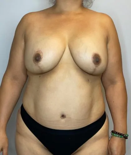 After Image: Mommy Makeover - front