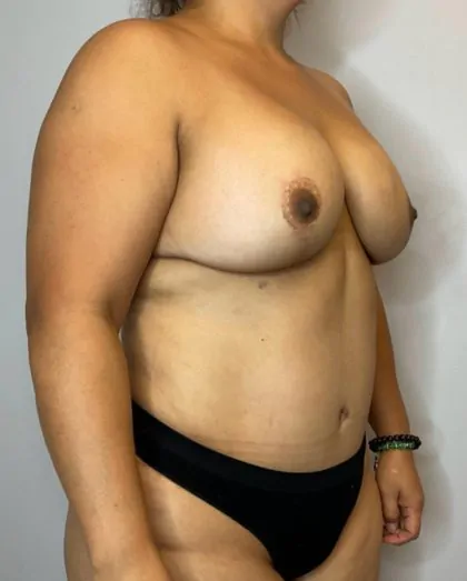 After Image: Mommy Makeover - right-front-oblique