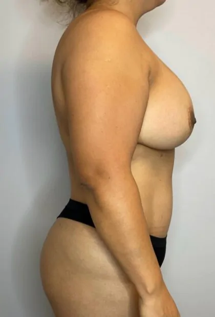 After Image: Mommy Makeover - right-side