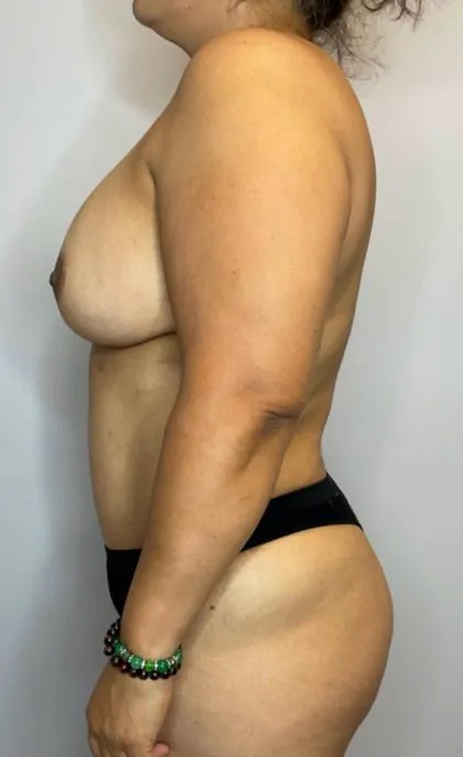 After Image: Mommy Makeover - left-side