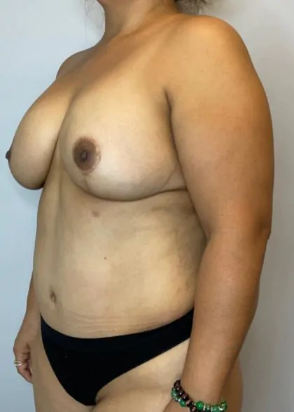 After Image: Mommy Makeover - left-front-oblique