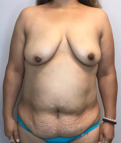 Before Image: Mommy Makeover - front