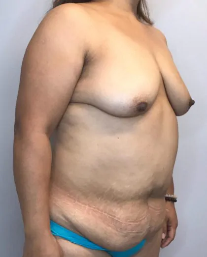 Before Image: Mommy Makeover - right-front-oblique