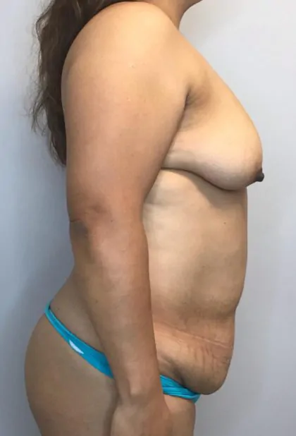 Before Image: Mommy Makeover - right-side