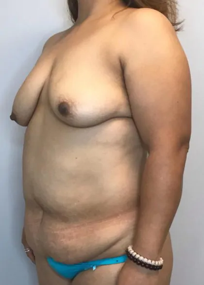 Before Image: Mommy Makeover - left-front-oblique