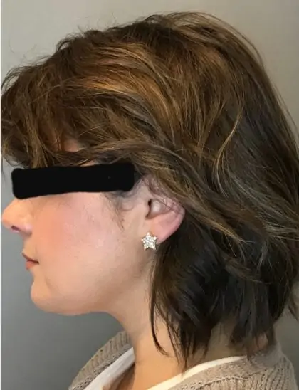 After Image: Renuvion Skin Tightening, Liposuction - left-side