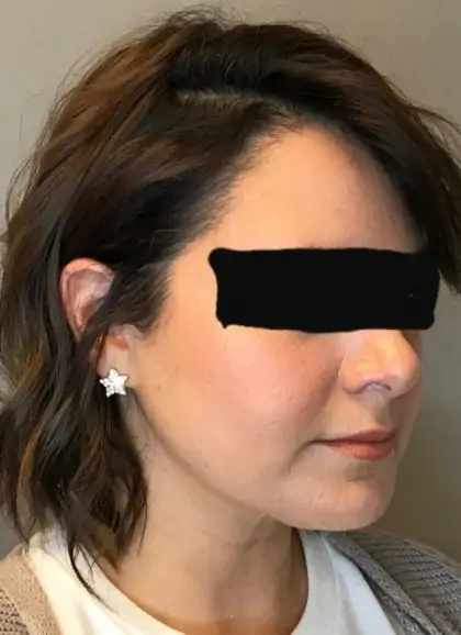 After Image: Renuvion Skin Tightening, Liposuction - right-front-oblique