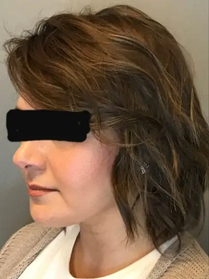 After Image: Renuvion Skin Tightening, Liposuction - left-front-oblique