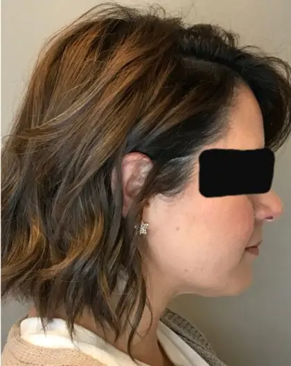 After Image: Renuvion Skin Tightening, Liposuction - right-side