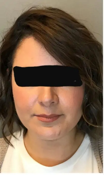 After Image: Renuvion Skin Tightening, Liposuction - front