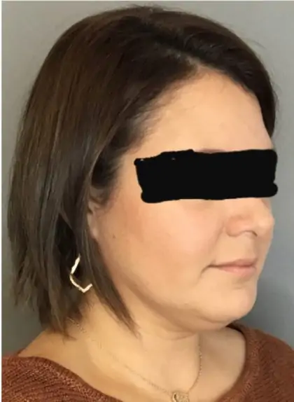 Before Image: Renuvion Skin Tightening, Liposuction - right-front-oblique