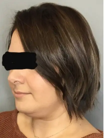 Before Image: Renuvion Skin Tightening, Liposuction - left-front-oblique