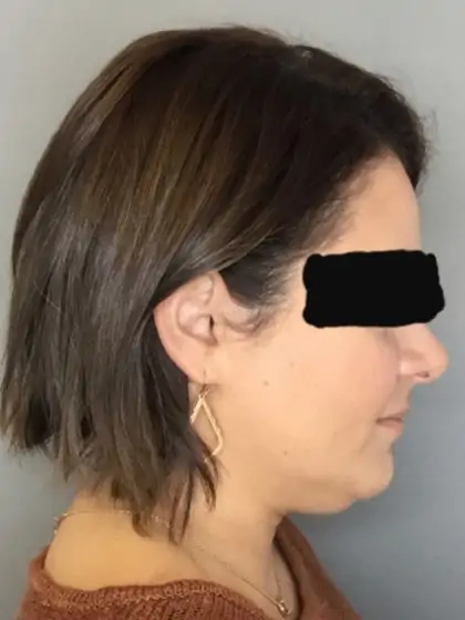 Before Image: Renuvion Skin Tightening, Liposuction - right-side