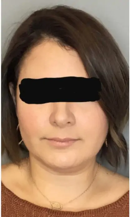 Before Image: Renuvion Skin Tightening, Liposuction - front