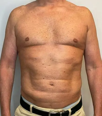 After Image: Renuvion Skin Tightening, Liposuction - front