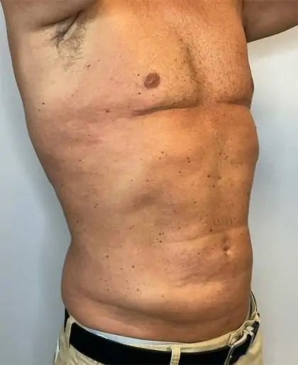 After Image: Renuvion Skin Tightening, Liposuction - right-front-oblique