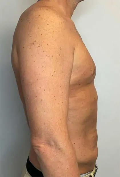 After Image: Renuvion Skin Tightening, Liposuction - right-side