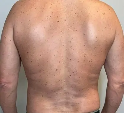 After Image: Renuvion Skin Tightening, Liposuction - back