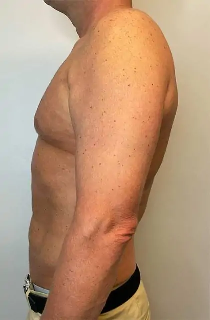 After Image: Renuvion Skin Tightening, Liposuction - left-side