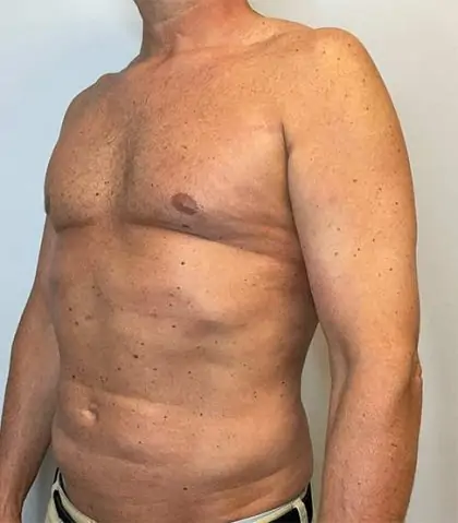 After Image: Renuvion Skin Tightening, Liposuction - left-front-oblique