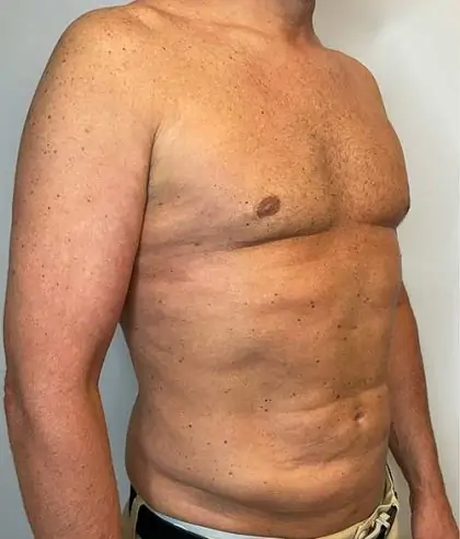 After Image: Renuvion Skin Tightening, Liposuction - right-front-oblique