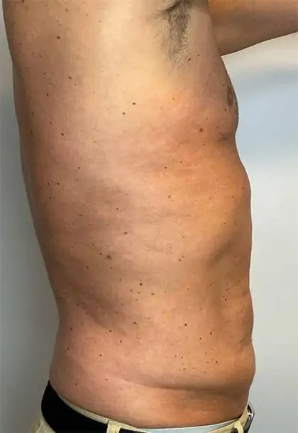 After Image: Renuvion Skin Tightening, Liposuction - right-side