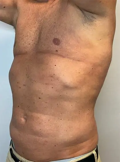 After Image: Renuvion Skin Tightening, Liposuction - left-front-oblique