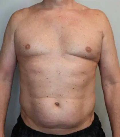 Before Image: Renuvion Skin Tightening, Liposuction - front