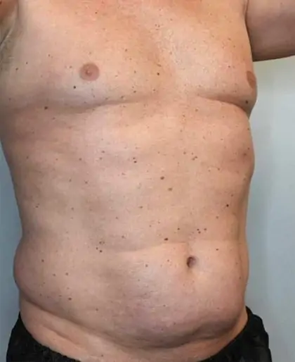 Before Image: Renuvion Skin Tightening, Liposuction - right-front-oblique