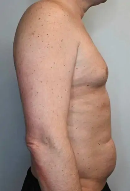 Before Image: Renuvion Skin Tightening, Liposuction - right-side