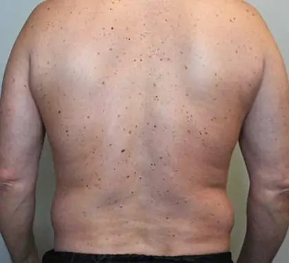 Before Image: Renuvion Skin Tightening, Liposuction - back