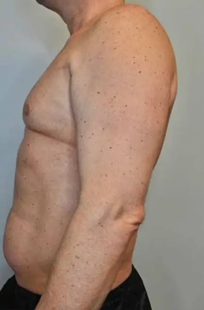 Before Image: Renuvion Skin Tightening, Liposuction - left-side