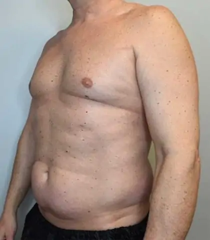 Before Image: Renuvion Skin Tightening, Liposuction - left-front-oblique