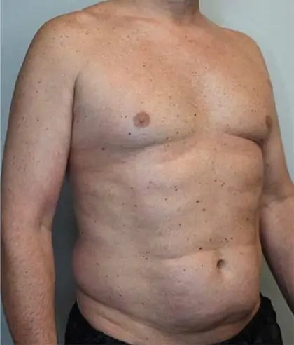 Before Image: Renuvion Skin Tightening, Liposuction - right-front-oblique