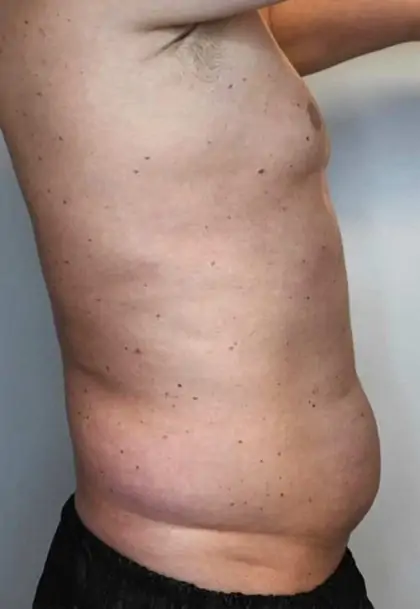 Before Image: Renuvion Skin Tightening, Liposuction - right-side