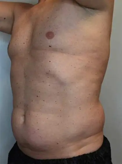 Before Image: Renuvion Skin Tightening, Liposuction - left-front-oblique